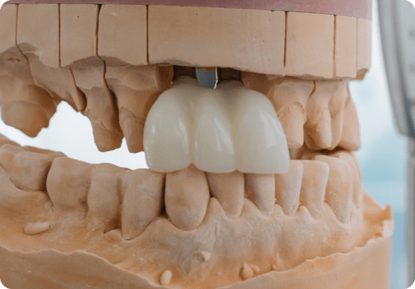 Prótese dentária sobre modelo de trabalho